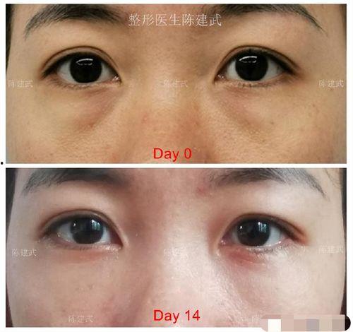 祛眼袋手术视频,专业视频带你了解眼部年轻化技巧