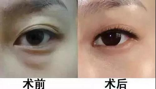 祛眼袋手术视频,专业视频带你了解眼部年轻化技巧